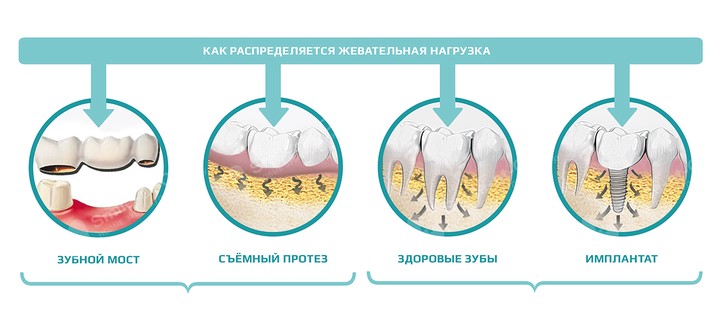 Стоматологи рассказали, как можно восстановить все зубы за 1 день и навсегда